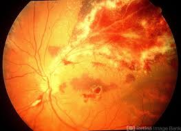 Image result for HIV Retinitis
