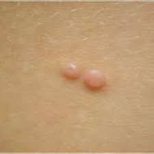 Check spelling or type a new query. Molluscum Contagiosum Do You Squeeze And Pop Or Not Hubpages