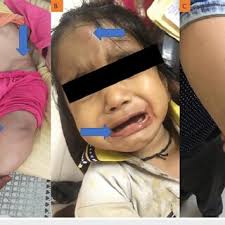 Severity of haemophilia in study