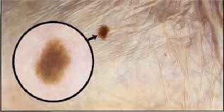 Melanomas can also occur in areas that don't receive much sun exposure, such as the soles of your feet, palms of your hands and fingernail beds. Essential Insights On Dermoscopy Of Plantar Pigmented Lesions Podiatry Today