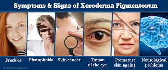 56 xeroderma pigmentosum is a genetically heterogeneous condition characterized by increased sensitivity to. Xeroderma Pigmentosum An Inherited Precancerous Condition