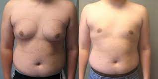 man boob surgery - Medcare SpainMedcare Spain