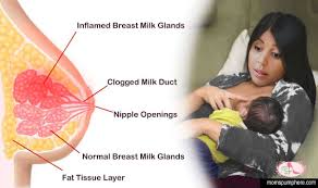 Breastfeeding women are most likely to get. Mastitis While Breastfeeding Causes And Treatments
