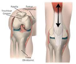 Patellofemoral Pain Syndrome Orthoinfo Aaos