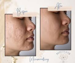 Where to get my Microneedling done?
