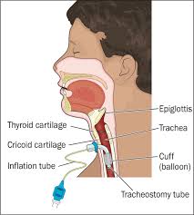 Image result for Tracheostomy
