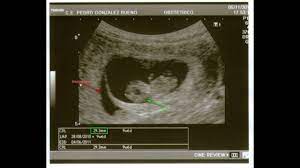Hematoma Retrocorial Ecografias Subchorionic Hematoma Ultrasounds Youtube