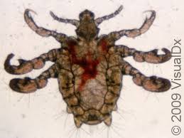 Image result for pubic lice symptoms