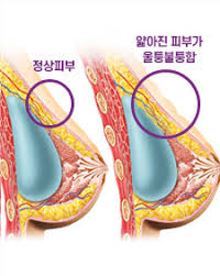Jun 09, 2021 · 대표적인 가슴 성형수술 부작용에는 구형구축과 보형물 파손, 리플링(보형물 윤곽이 보이는 현상) 등이 있으며, 불만족 사례의 경우 모양이나 대칭, 크기에 대한 것들이 많다. ê°€ìŠ´ìž¬ìˆ˜ìˆ  ë·°ì„±í˜•ì™¸ê³¼