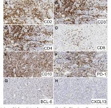 Vincent's hospital, melbourne, vic, australia; Figure 3 From Angioimmunoblastic T Cell Lymphoma Of The Oral Cavity Presenting As Gingival Mass Report Of The Histopathologic And Molecular Characteristics Of An Unusual Case Featuring Clonal T Cell Receptor G Gene Rearrangement