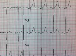 Image result for Early Repolarization
