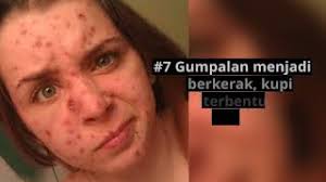 Bagaimana dengan rasa gatal yang melampau? Makanan Untuk Cacar Air Chicken Pox Rawatan Doctoroncall