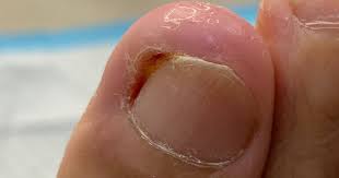 Image result for paronychium