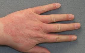 как избавиться от экземы на руках в домашних условиях Ekzema Na Rukah Foto Lechenie I Mazi Chem Lechit Ekzemu V Domashnih Usloviyah