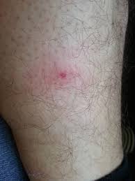 Insektenstich Alle Jahre Wieder C Dev