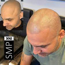 The gallery of photos and pictures in our possession is not enough to convince you about scalp micropigmentation, then maybe social media . Scalp Micropigmentation Before And After Photos Smp Ink