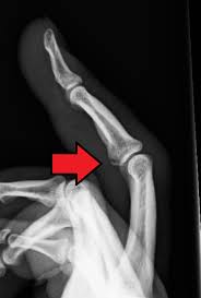 An avulsion fracture is a bone fracture which occurs when a fragment of bone tears away from the main mass of bone as a result of physical trauma. Avulsion Fracture Wikipedia