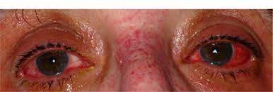 Patient With Acute Stevens Johnson Syndrome At The Time Of Initial Download Scientific Diagram