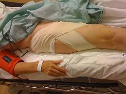 Resultado de imagen de post cateterismo femoral