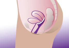 Image result for Pessary