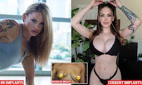 Model who was left with 'mangled' breasts had to $100,000 on breast  surgeries | Daily Mail Online