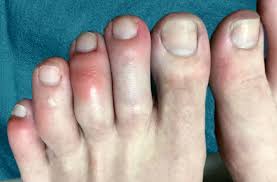 Athlete's foot is an itchy and red rash that usually affects the soles of the feet and between the toes. Are Covid Toes And Rashes Common Symptoms Of The Coronavirus Health Essentials From Cleveland Clinic