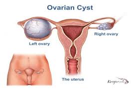 Ramai dalam kalangan wanita berhadapan dengan masalah kesihatan ini namun. Makan Supplemen Tak Boleh Rawat Ovarian Cyts Doktor Nasihat Wanita Supaya Tak Tertipu