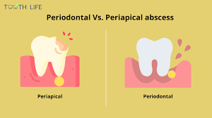 Image result for Periodontal Abscess