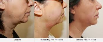 Can jowls can be improved without surgery? Ultraformer Iii Hifu Jowl And Jawline Tightening At Cheshire Lasers