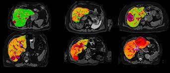 Landmark Study Launched To Detect Liver Cance Eurekalert