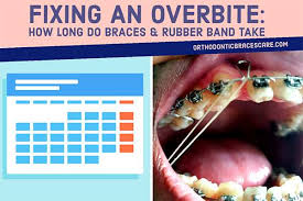 If you have a significant overbite and want to know how to fix. How Long Do Braces And Rubber Band Take To Fix Overbite Orthodontic Braces Care