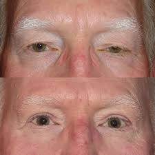 Bilateral Upper and Lower Lid Blepharoplasty