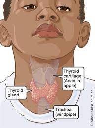 Hypothyroidism (underactive thyroid) is a condition in which your thyroid gland doesn't produce enough of certain crucial hormones. Thyroid Disease And Diabetes