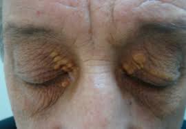 Image result for xanthelasma of eyelid