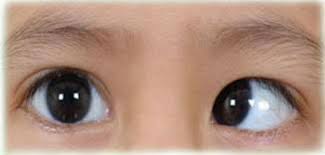 Tests for organic causes should be done based on the history and physical examination (see table: Retinoblastoma Aravind Eye Care System