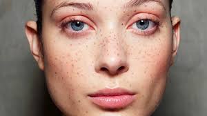 Image result for Freckled skin