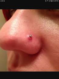Keloid Nose Piercing