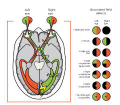 Image result for Visual Field Deficit