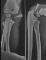 The fracture line intersects the distal humerus and the medial j. Medial Epicondylar Fractures Pediatric Pediatrics Orthobullets