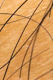 Or if you cut naturally curly hairtoo short, the sharpened end of the. Ingrown Hair Cyst Treatments Causes And Prevention