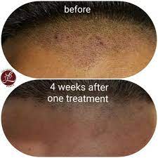 Laser hair removal and electrolysis both work on targeting the hair follicles that are under the surface of the skin. Queens Laser And Electrolysis Hair Removal 30 Photos 77 Reviews Laser Hair Removal 87 08 Justice Ave Elmhurst Ny United States Phone Number