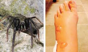 Researchers proved otherwise, since there are no reported cases of deaths. Woman Nearly Loses Her Leg After False Widow Spider Bite Uk News Express Co Uk