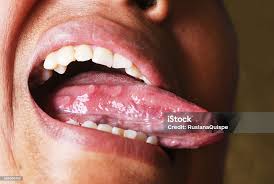 Image result for Puchýře na jazyku