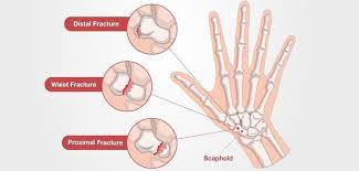 Image result for Scaphoid Fracture Signs