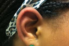 Medical Mystery A Girl S Red Ears A Mother S Intuition