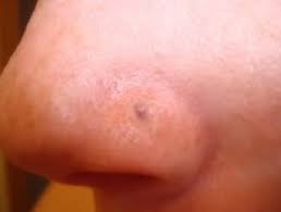 Thanks to the antibacterial and antiseptic properties, aloe vera gel can help to heal the keloid scars very fast and effectively at the initial stage. Nose Piercing Scars Causes Treatment Authoritytattoo