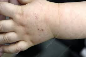 Palpable purpura is purpura than can be felt, due to inflammation of the blood vessels (vasculitis) Purpura Spots Stock Image C016 5362 Science Photo Library