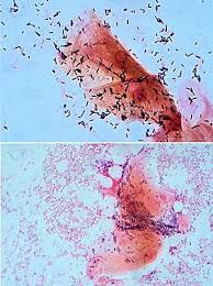 Federal clinical guidelines for management of patients with bacterial vaginosis, 2013. Bacterial Vaginosis Wikipedia