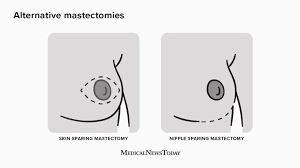 Image result for Mastectomy