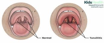 Image result for Tonsillitis